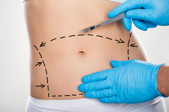 Abdominoplastik Chiemgau